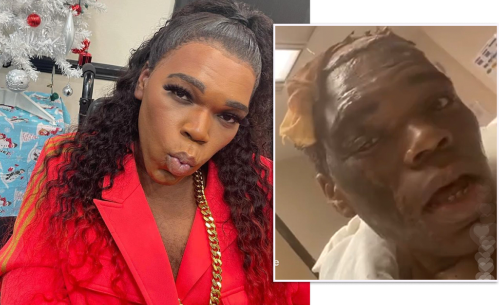 IN CASE YOU MISSED IT Rolling Ray Displays Painful Burns in Hospital